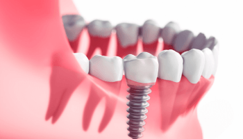 Implantes Dentales en Cajamarca - Star Dent - Lorena Alegría