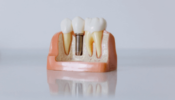 Implantes Dentales en Cajamarca - Star Dent - Lorena Alegría